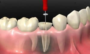 Chữa tuỷ răng và những cái cần biết