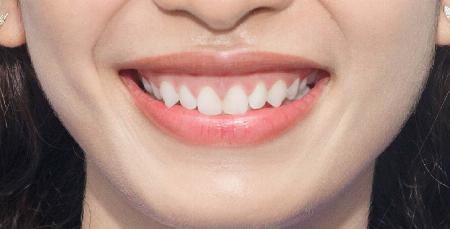 Chữa Cười Hở Lợi