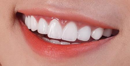 Thẩm Mỹ Răng Sứ