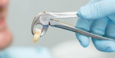 Nhổ Răng Khôn Chuyên Sâu