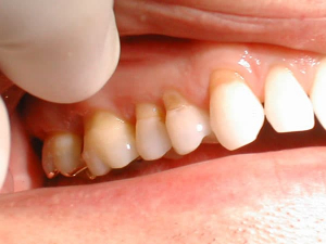Mòn cổ răng là sao và cách điều trị mòn cổ răng