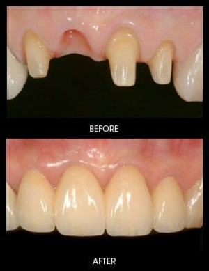 Tác hại và cách khắc phục khi bị mất răng