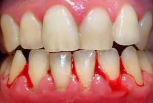 Chảy máu chân răng – Nguyên nhân & cách chữa trị