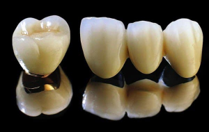 Răng sứ kim loại thường là gì?