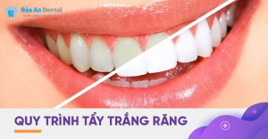 Tẩy trắng răng tại nha khoa Bảo An Dental Tân Bình