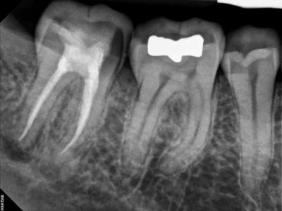 Chữa tuỷ răng và những cái cần biết