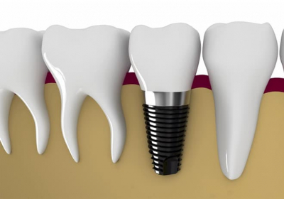 Trồng Răng Implant