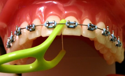 Vệ sinh răng miệng sau khi niềng răng sao cho đúng?