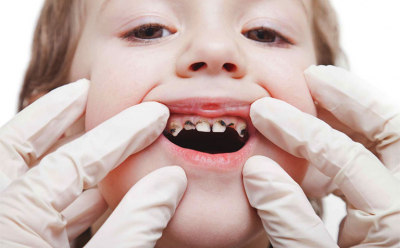 Các phương pháp điều trị răng sâu cho trẻ? Nhổ răng sâu có thật sự tốt?