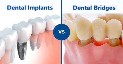 Nên sử dụng dịch vụ làm cầu răng hay cấy ghép Implant khi bị mất răng?