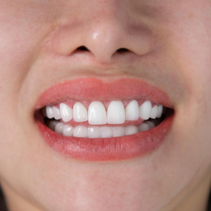 Bọc sứ hay Dán sứ có ảnh hưởng đến răng thật không? 