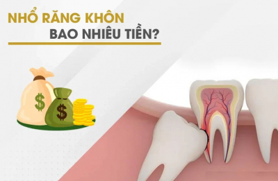 Chi phí nhổ răng khôn bao nhiêu là hợp lý nhất hiện nay?