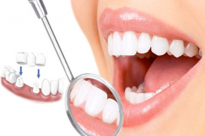 Bọc răng sứ có phải lấy tủy không ? Lấy tủy răng có đau không ?