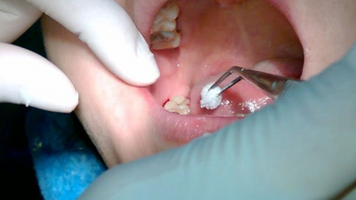 Nhổ răng khôn có đau không, có ảnh hưởng gì không?