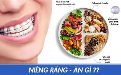 Niềng răng nên ăn gì? Kiêng những thực phẩm gì? Đâu là chế độ ăn uống hợp lý khi niềng răng