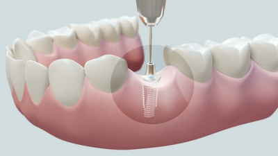 Cấy ghép Implant - Bí quyết phục hồi răng đã mất