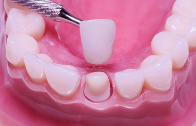 Quy trình trồng răng sứ chuẩn xác, an toàn & không đau