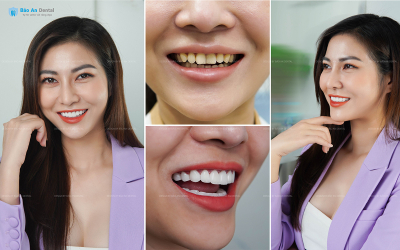 Tại sao nên chọn bọc thẩm mỹ răng sứ tại Bảo An Dental?