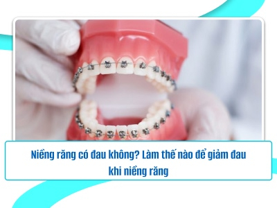 Niềng răng có đau không? Làm thế nào để giảm đau khi niềng răng